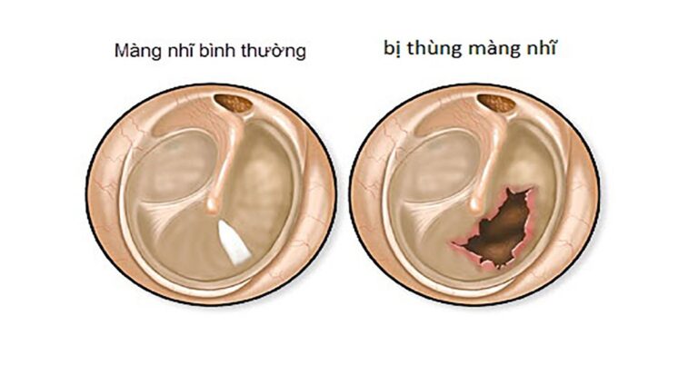 Tỷ lệ phần trăm tổn thương cơ thể do tổn thương tai – mũi – họng – răng – hàm – mặt