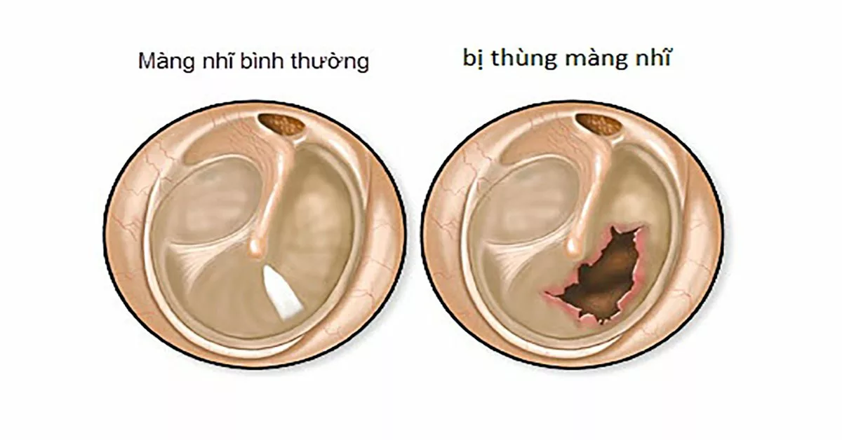 Tỷ lệ phần trăm tổn thương cơ thể do tổn thương tai - mũi - họng - răng - hàm - mặt Tỷ lệ phần trăm tổn thương cơ thể do tổn thương tai – mũi – họng – răng – hàm – mặt